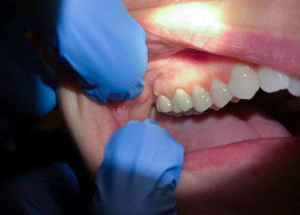Best Emergency Treatment for Oral Infections in Breckinridge Center, KY